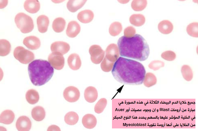 ابيضاض الدم النقوي الحاد Acute myeloid leukaemia