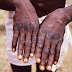 Suspected monkeypox outbreak in Nigeria