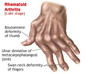 Nursing Assessment for Rheumatoid Arthritis