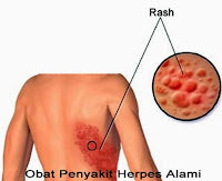 Cara Menghindari dan Mengobati Penyakit Herpes Sampai Sembuh Tuntas