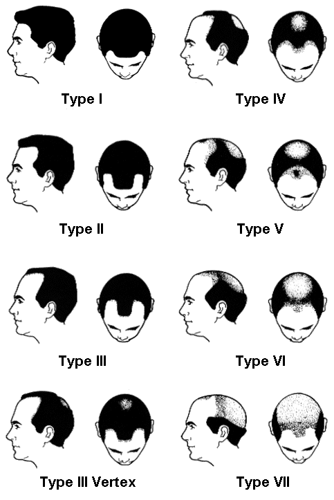 Nutrients Causing Hair Loss : How To Overcome The Problem Of Female Pattern Baldness