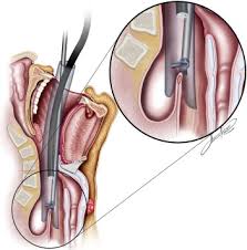 Dohlmanns' zenker diverticulum