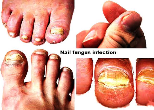 Nail fungus infection.