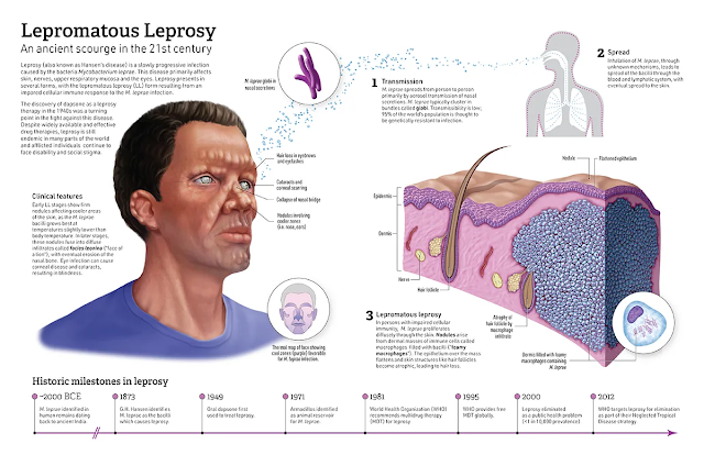 The Prophet's Love for People with Leprosy: Know the Causes and Symptoms