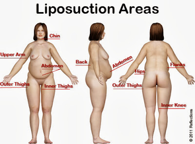 How much does liposuction cost