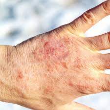 Symptoms Of Dehydration Of Water