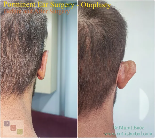 Pinnaplasty,Otoplasty,Ear plastic surgery,Cosmetic Ear Surgery,Ear Reshaping,Auriculoplasty,Surgical Correction of Prominent Ears,Protruding Ear Surgery,