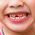Trẻ em trồng răng implant được không
