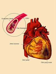 Obat Tradisional Penyakit Jantung Koroner Alami