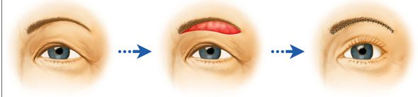 quy trình Phẫu thuật mắt to