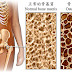 骨质疏松osteoporosis (osteopenia)- drink more milk?