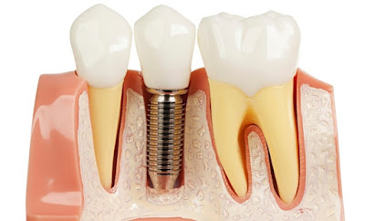 Công nghệ cấy ghép implant