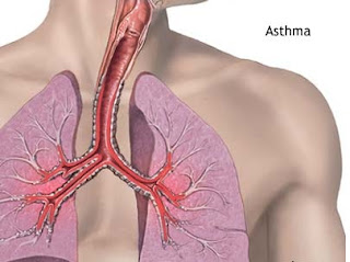 Some Fundamental Facts About Asthma
