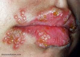 Herpes di Mulut Orang Dewasa Bisa di Sembuhkan
