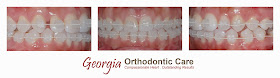 Clear braces, invisible braces, Ceramic braces, Esthetic braces, cosmetic braces, lawrenceville orthodontist, norcross orthodontist, duluth, buford, dacula, lilburn, snellville, grayson, sugar loaf, sugar hill, doraville, Suwanee, Hamilton Mill, Gwinnett, Georgia, GA