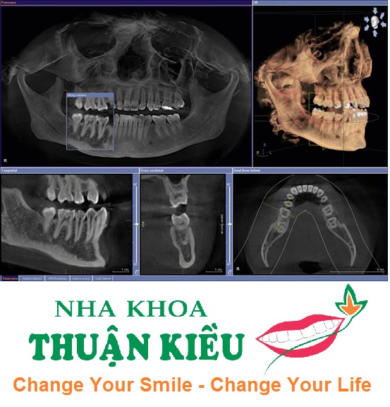 cay-ghep-rang-implant-phan-mem-ct-scan-hien-dai-2015-nha-khoa-thuan-kieu-2015