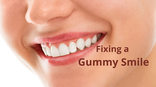 How to Fix a Gummy Smile