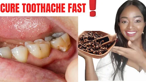 Use Clove Oil As Toothache Remedy – How to Apply Clove Oil for Toothache