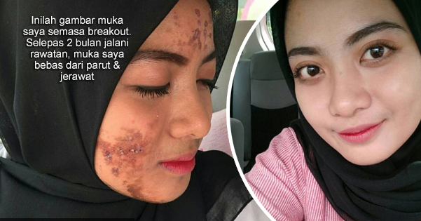 'Inilah gambar muka saya semasa breakout, tapi dah pulih 