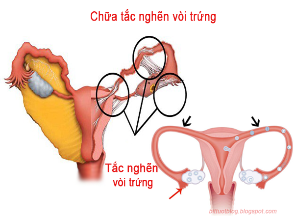 Chữa tắc nghẽn vòi trứng