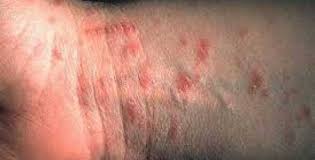 Obat gatal herbal karena kurap