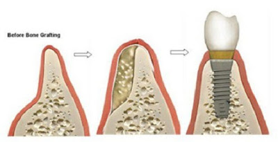 Xương hàm bị tiêu có trồng implant được không?