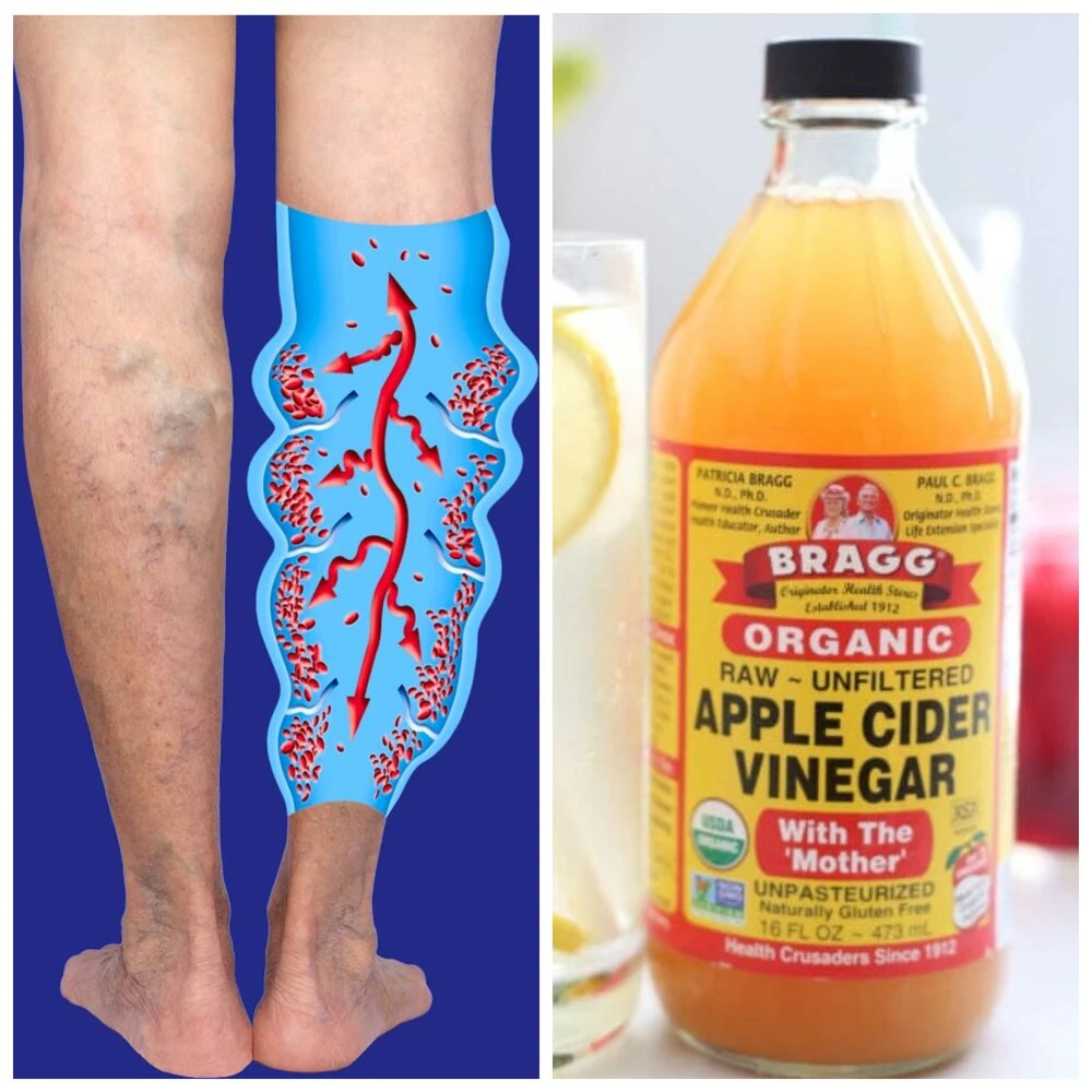 How to Get Rid of Varicose Veins Forever with 8 Natural Remedies