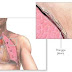 Kolaps Paru-Paru (Pneumothorax)