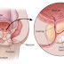 5 Causes and Risk Factors of Prostate Cancer