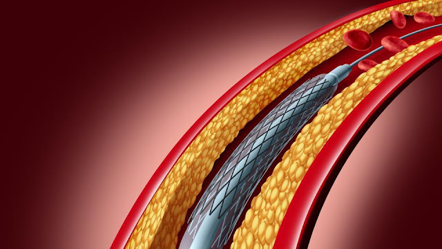 Bioabsorbable Stents Market