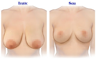 Phẫu thuật nâng ngực chảy xệ có tốt không ?