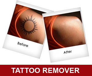 tattoo removal