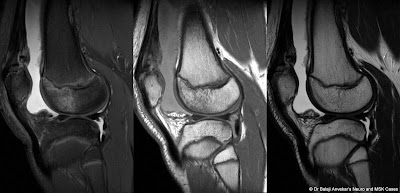 Osteochondrosis%2Bpatella.jpg