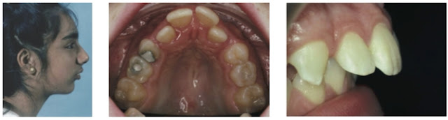 Geniz eti büyümesi - Adenoid face - Geniz eti yüzü - Geniz eti büyümesine bağlı çene yapısında bozulma - Geniz eti büyümesine bağlı dişler nasıl etkilenir? - Çocuklarda geniz eti büyümesi çene ve dişleri nasıl etkiler? - Adenoid hipertrofisi - The Mouth Breathing Syndrome (MBS - Ağız Solunumu Sendromu) - Geniz eti büyümesi kendiliğinden ne zaman durur? - Geniz eti filmi nasıl çekilmelidir?