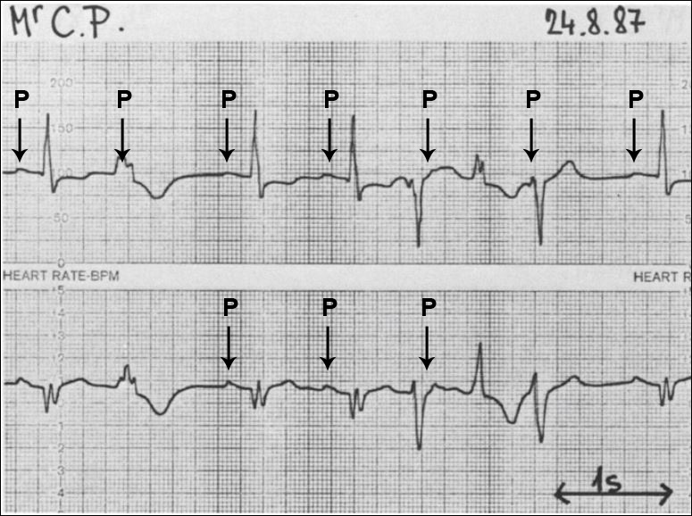 Аберрантные экстрасистолы. Аберрантный комплекс QRS. Аберрантные экстрасистолы на ЭКГ. Желудочковая экстрасистолия по типу блокады правой ножки пучка Гиса. Аберрантные желудочковые комплексы на ЭКГ.