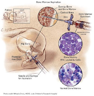 apa yang dimaksud Leukemia sebab gejala dan cara pengobatan