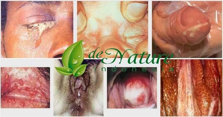 Obat Penis Sakit Keluar Nanah