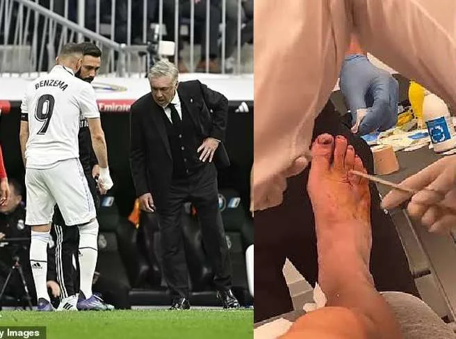 Karim Benzema receives FIVE stitches after a vicious stamp against Rayo Vallecano