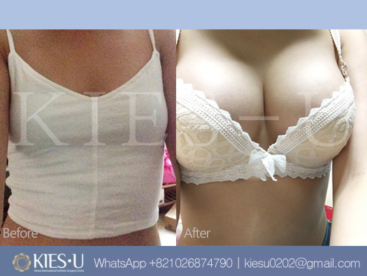 Dr. Lee Breast augmentation Korea: Deciding on the upper body shape and  breast implant