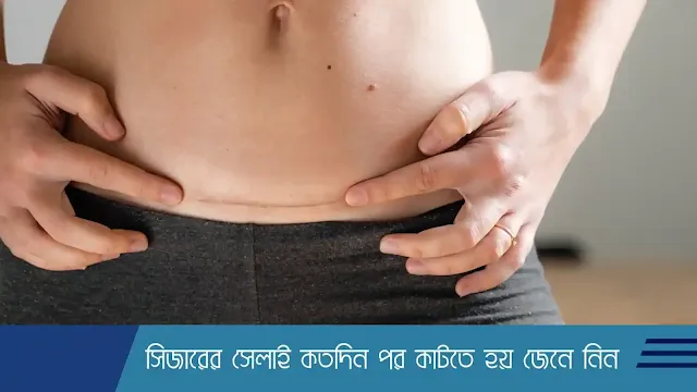 সিজারের সেলাই কতদিন পর কাটতে হয়