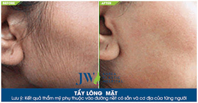 Hình ảnh khách hàng trước và sau khi tẩy lông mặt bằng Laser Aileen tại Skincare JW