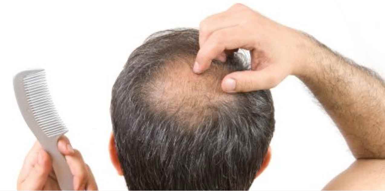 Cara mengatasi rambut  rontok  parah berlebihan Informasi Obat