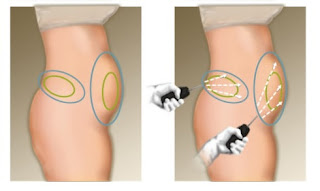 Liposuccion  ventre laser : Photo avant et après