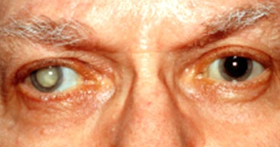cataract eye disease