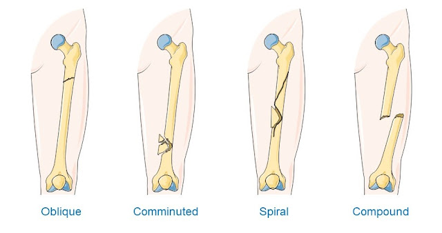 Open Fracture Treatment | Open Bone Fracture Surgery