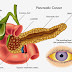 What Causes Pancreatic Cancer ? – Best Answers 