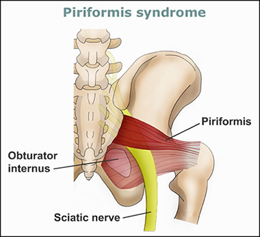 Piriformis Syndrome