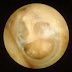 How is a Hole in the Eardrum Repaired?