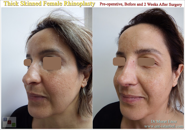 Thick and asymmetrical nose job, Female rhinoplasty, Asymmetric female nose aesthetics, Oily nose, Crooked nose, Scoliotic nose