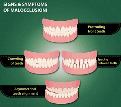 Malocclusion